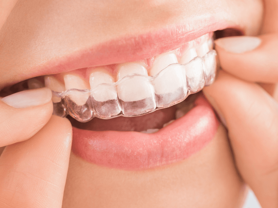 การจัดฟันใส (Invisalign)