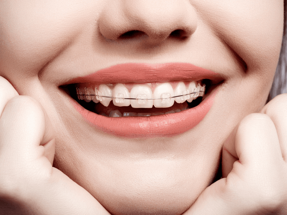 Clear braces