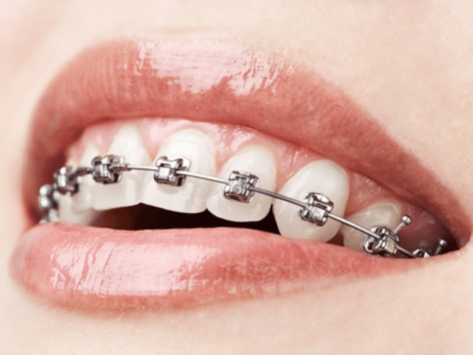 Damon braces
