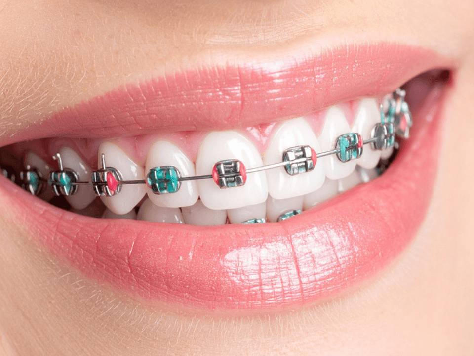 Standard metal braces