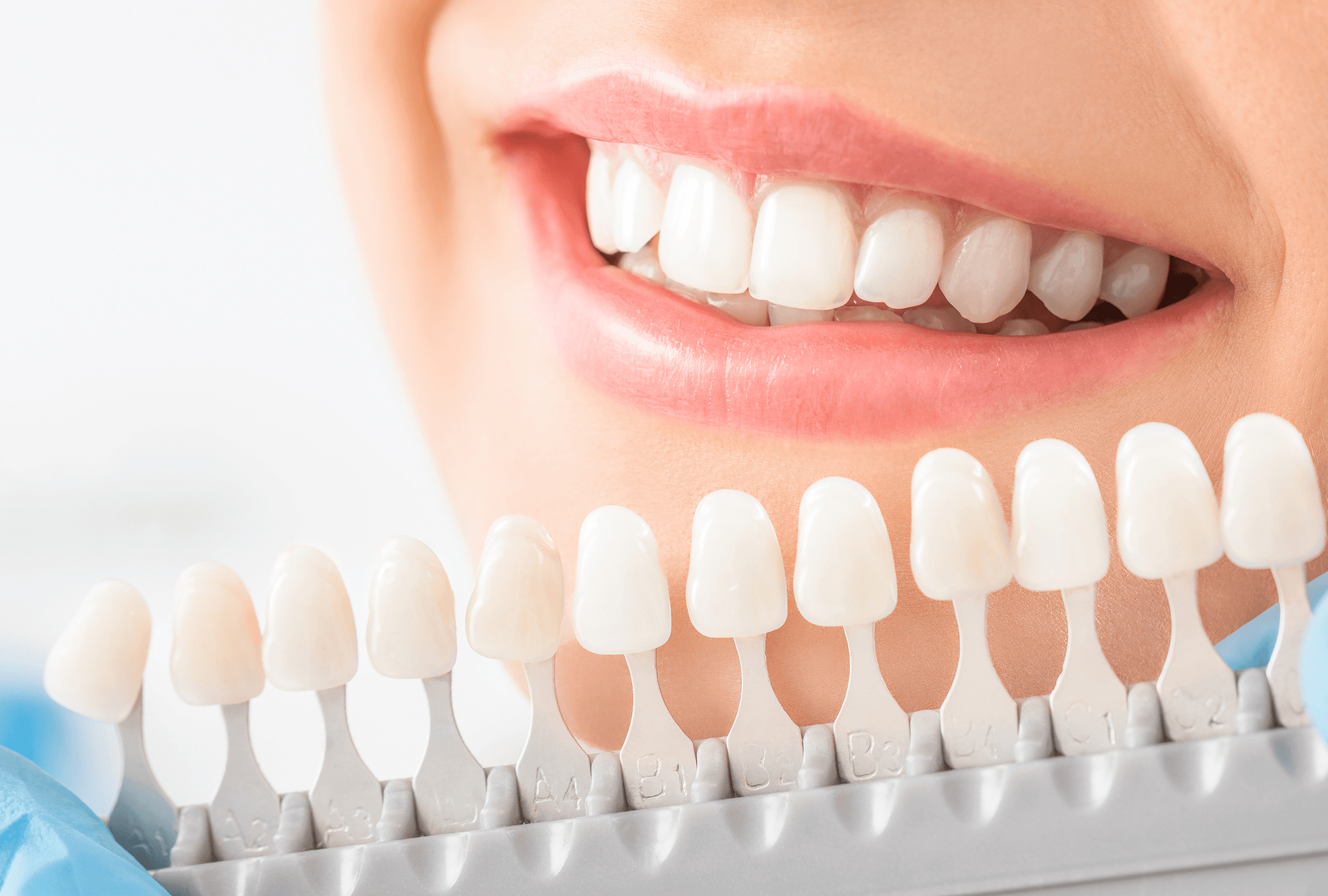 วีเนียร์ (Veneers)